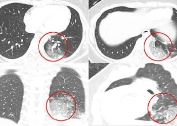 ABD’li doktorlar Covid-19’lu çocukların BT taramalarını inceledi