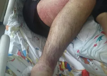 Yılan ısırmasıyla zehirlendi, panzehir 26 saatte bulundu