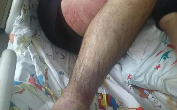 Yılan ısırmasıyla zehirlendi, panzehir 26 saatte bulundu
