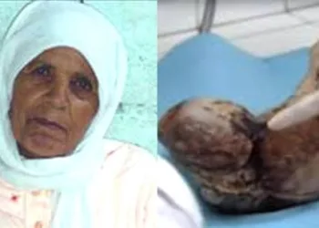 Karnındaki bebeği 50 yıl doğurmadı
