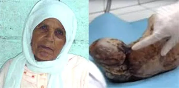 Karnındaki bebeği 50 yıl doğurmadı