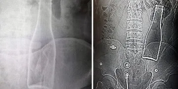 Makatından sokulan soda şişesi ameliyatla çıkarıldı