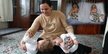 Başlarından yapışık siyam ikizleri şehir hastanesine yerleştirildi