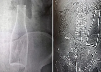 Vücudundan soda şişesi çıkan Afgan genç konuştu