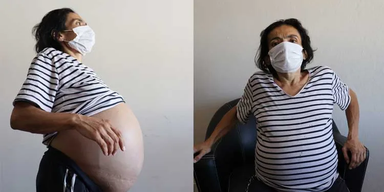 Karnındaki 15 kiloluk tümörle yardım bekliyor