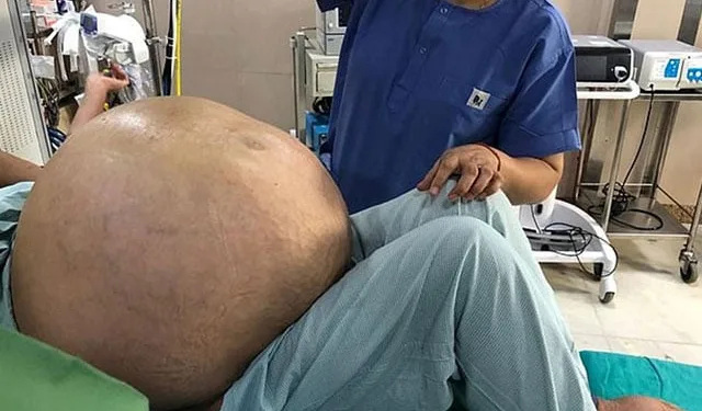 Dünyanın en büyük yumurtalık tümörü çıkarıldı