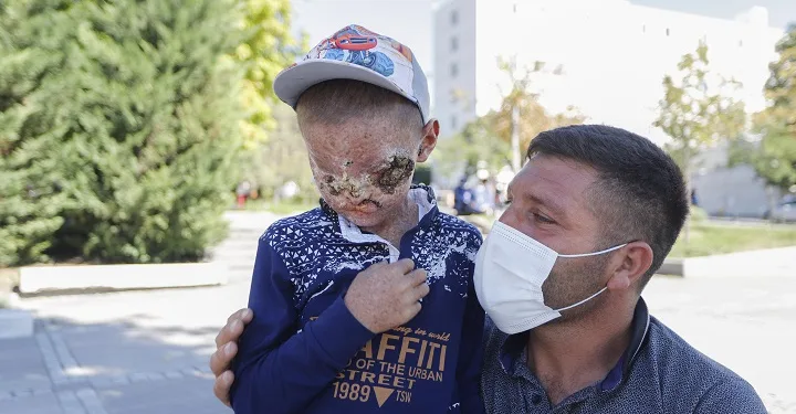 Cilt kanseri Salih’in tedavisi başladı