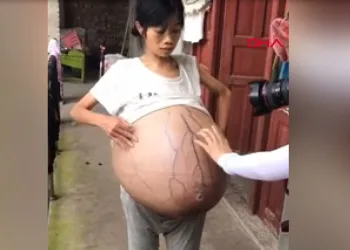 Aniden şişmeye başlayan karnı 20 kiloya ulaştı