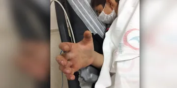 Zehirli yılanın ısırdığı Civan’ın sağlık durumu ciddiyetini koruyor