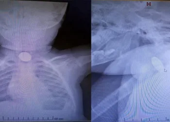 1 yaşındaki bebek 25 kuruş yuttu