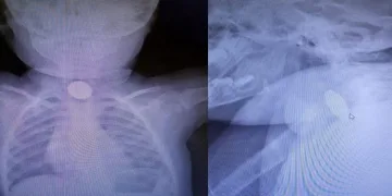 1 yaşındaki bebek 25 kuruş yuttu