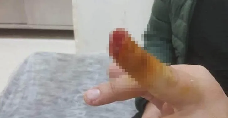 Tartıştığı güvenlik görevlisinin parmağını ısırıp, kopardı