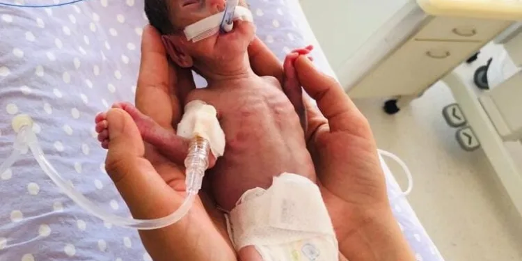 520 gram doğan Nisa bebek yaşama tutundu