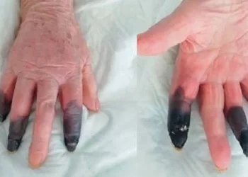 İtalya’da koronavirüs hastası kadın kangren oldu: 3 parmağı kesildi
