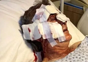 Kafesinden kaçan maymunun saldırısına uğradı