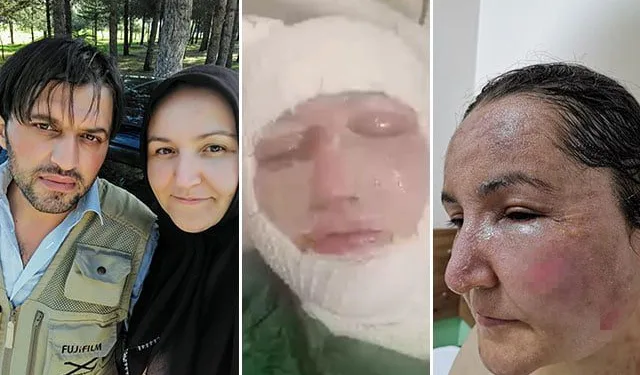 Eşini kızgın yağ ve kaynar su ile yaktı