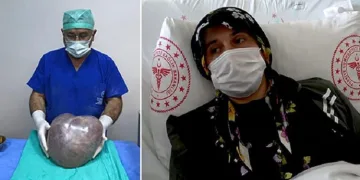 Hamile olduğunu düşünüyordu, karnından 6,5 kilo kist çıktı