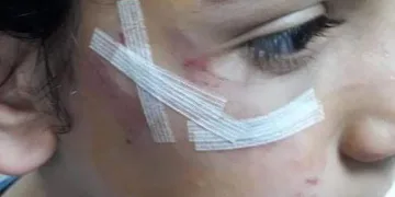 Bursa’da 8 yaşındaki çocuk köpek saldırısına uğradı