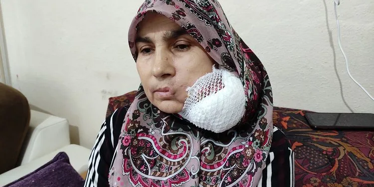 Yüzünde çıkan yara bu hale geldi