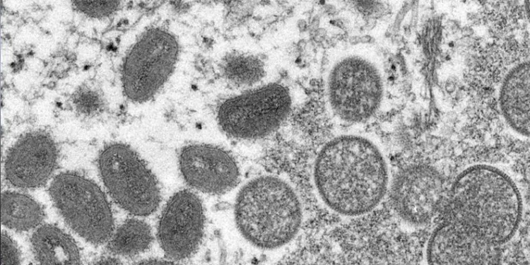 Maymun çiçeği virüsü alarmı! 5 ülkede görüldü