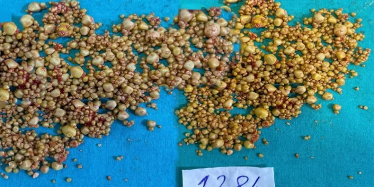 Karın ağrısı şikayetiyle gitti hepsi safra kesesinden çıktı