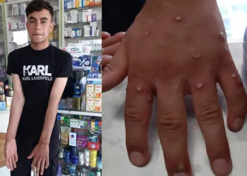 Türkiye’de maymun çiçeği şüphesi! Karantinadalar