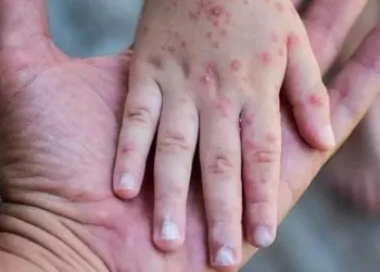 DSÖ maymun çiçeğinde Türk hastayı örnek gösterdi