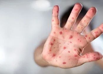 Dünyada maymun çiçeği vaka sayısı 35 bini aştı