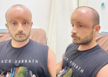 Başındaki şişliğin sebebi belli oldu