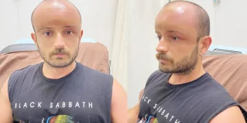 Başındaki şişliğin sebebi belli oldu