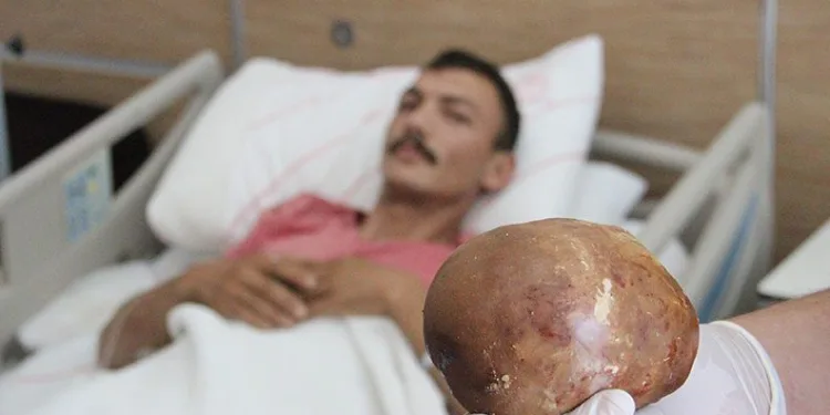 Mesanesinden 1 kilo taş çıktı