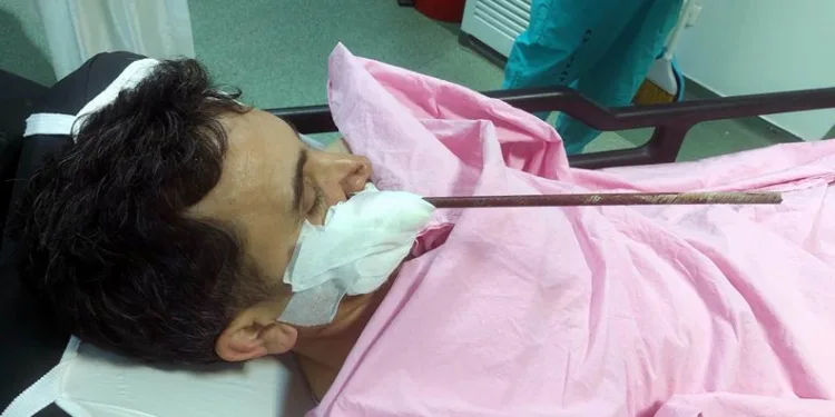 Samsun’da yüzüne saplanan demirle hastaneye kaldırıldı