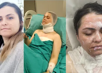 Eski eşinin yüzüne kimyasal madde attı