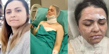 Eski eşinin yüzüne kimyasal madde attı