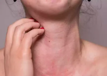 Çevre kirliliği alerji vakaları