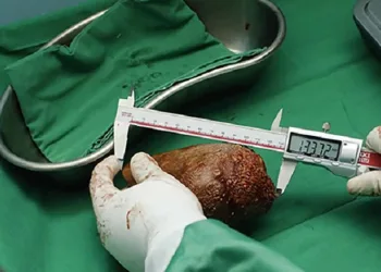 801 gram ağırlığında böbrek taşı