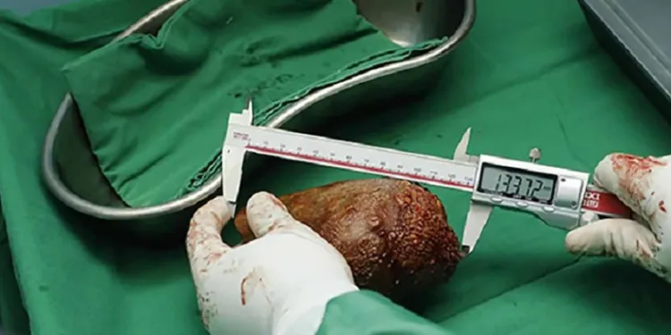 801 gram ağırlığında böbrek taşı