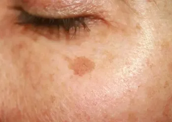Leke tedavisinde güneşten korunun