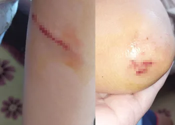 Sokak köpeklerinin saldırdığı çocuk babası sayesinde kurtuldu