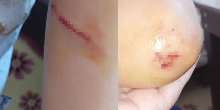 Sokak köpeklerinin saldırdığı çocuk babası sayesinde kurtuldu