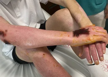 Deodorant sıkılırken çakılan çakmak sonları oluyordu