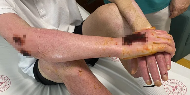 Deodorant sıkılırken çakılan çakmak sonları oluyordu