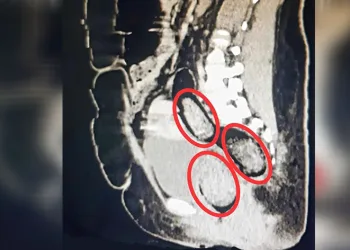 Kadının bağırsaklarından uyuşturucu çıktı