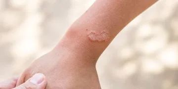 Şiddetli kaşıntı uyuz belirtisi olabilir