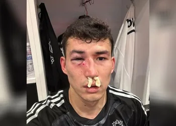 Beşiktaş: “Zaynutdinov’un burnunda ve göz çukurunda kırık saptanmıştır”