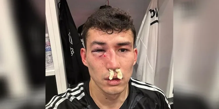 Beşiktaş: “Zaynutdinov’un burnunda ve göz çukurunda kırık saptanmıştır”