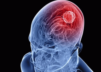 Dirençli epilepside konforlu yöntem