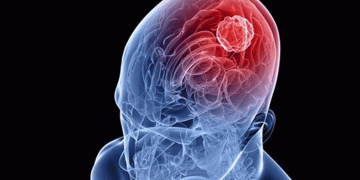 Dirençli epilepside konforlu yöntem