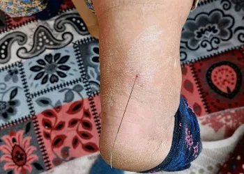 Ayak topuğundan 37 santim tel çıktı