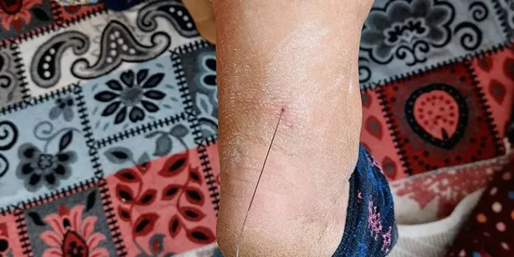 Ayak topuğundan 37 santim tel çıktı